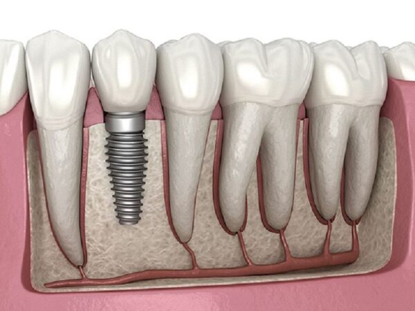 You don’t have to loathe your smile; dental implants can transform it