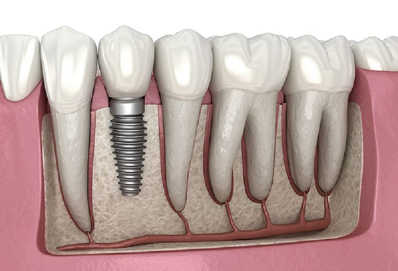You don’t have to loathe your smile; dental implants can transform it