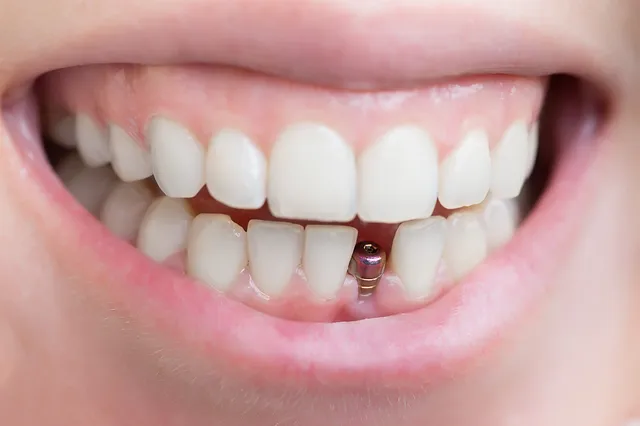 Unleashing the Potential Benefits of Dental Implants