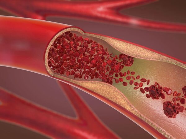 Atherosclerosis in Women: Unique Risk Factors