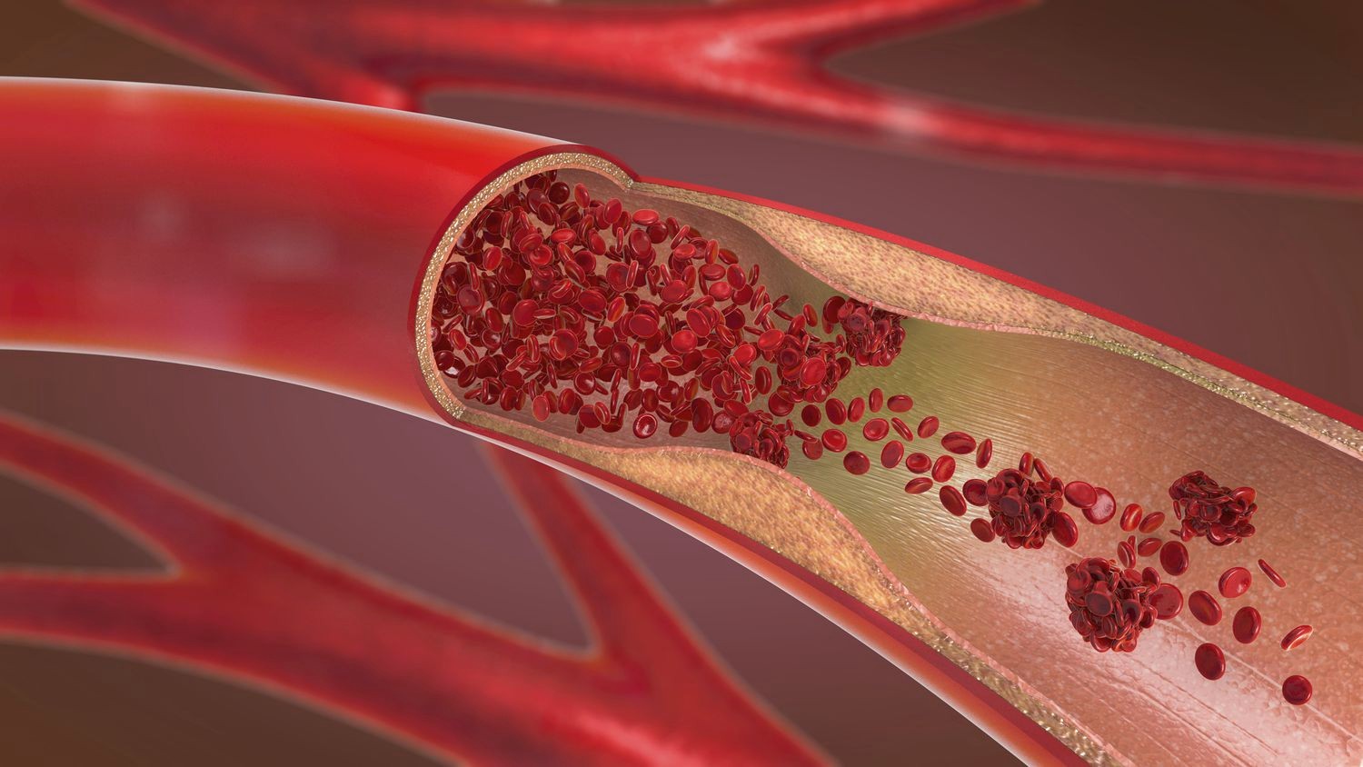 Atherosclerosis